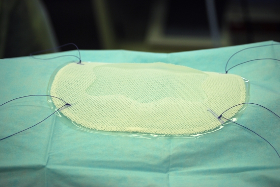Different surfaces and shapes for laparoscopic mesh