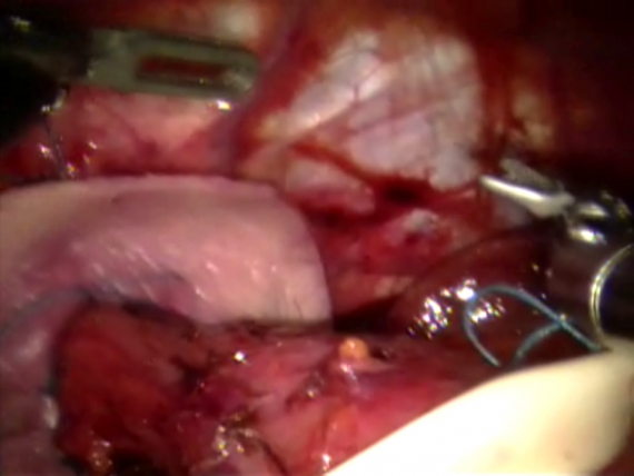 Robotic placement of biologic mesh during hiatal hernia repair