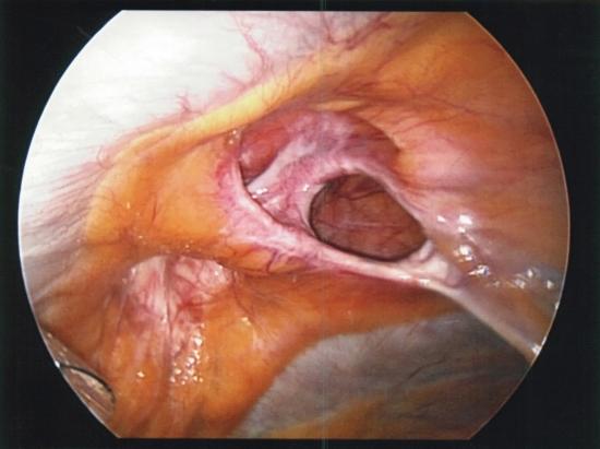 Ventral hernia mesenteric and fascial defects