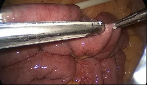  Connecting intestine during gastric bypass