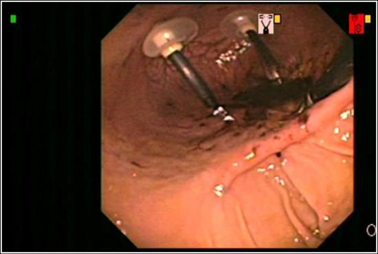 Orientation Difficulties during Intragastric Robotic Surgery