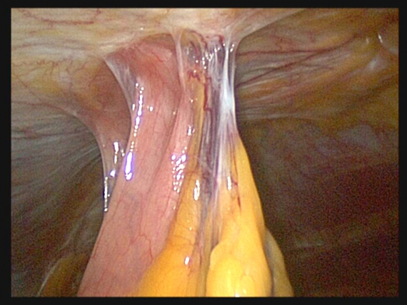 Intestinal adhesions stuck to abdominal wall