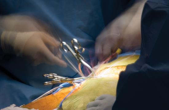 Retractors during open surgery