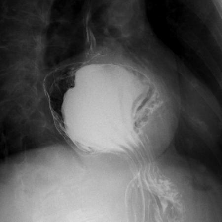 Stomach herniation during hiatal hernia