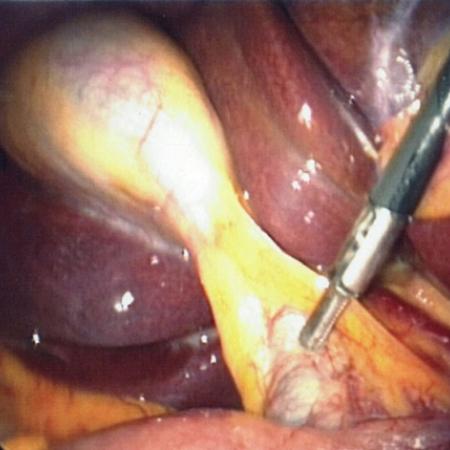 Critical view during laparoscopic cholecystectomy