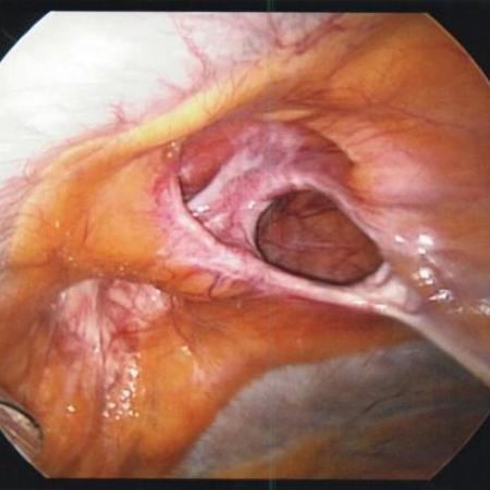 Ventral hernia mesenteric and fascial defects