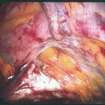 Laparoscopic inguinal hernia repair with direct type hernia