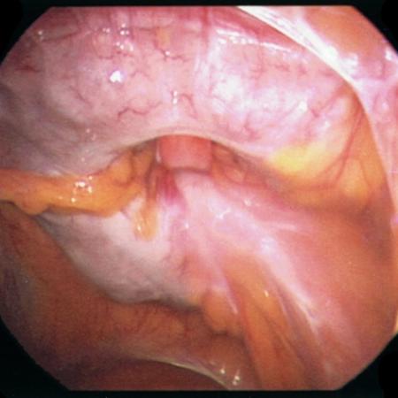 Abdominal intestines inside giant ventral hernia