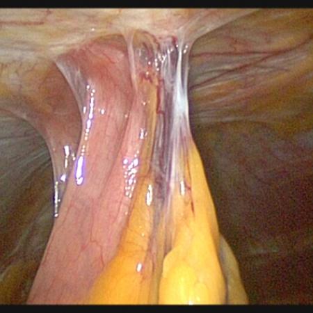 Intestinal adhesions stuck to abdominal wall