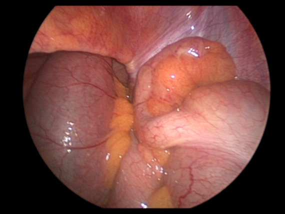 Inflamed appendix during laparoscopic appendectomy