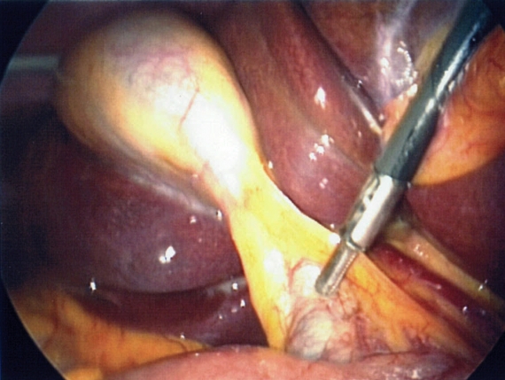 Photos | Critical view during laparoscopic cholecystectomy