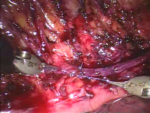 Suturing graft to ganglia during robotic sympathectomy reversal