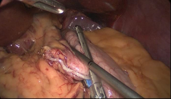Stomach stapled into small pouch during gastric bypass