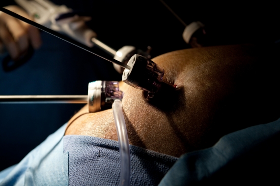 Laparoscopic ports during weight-loss surgery