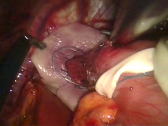 Intracorporeal view of robotic paraesophageal hernia repair