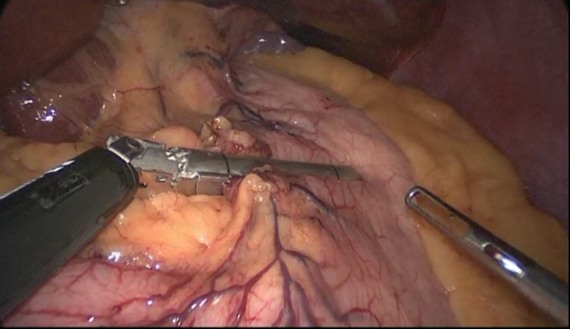 Initial stapling of stomach pouch across lesser curvature