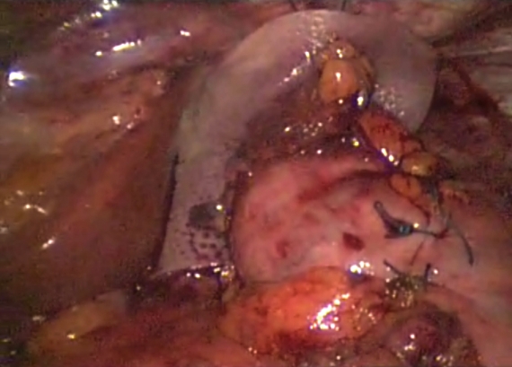 Intracorporeal view of stomach wrap to reconstruct gastroesophageal sphincter