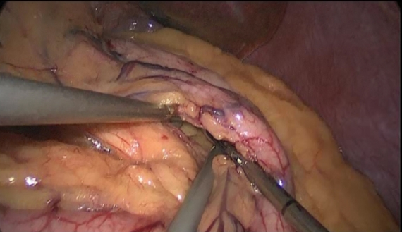 Dissecting Stomach Pouch during laparoscopic gastric bypass