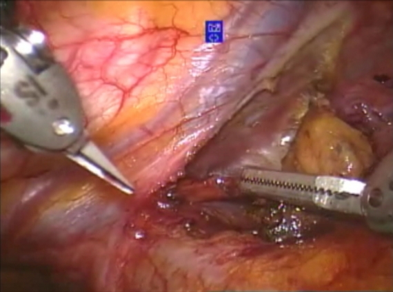 Robotic dissection of superior horns of thymus