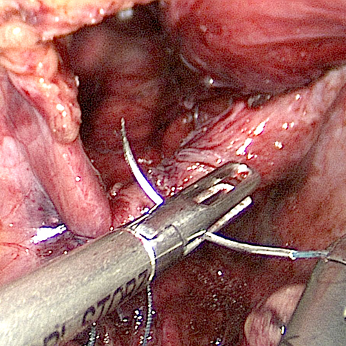 Diaphragmatic hernia being laparoscopic sutured
