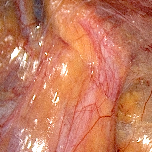 Intestine herniating through direct inguinal hernia