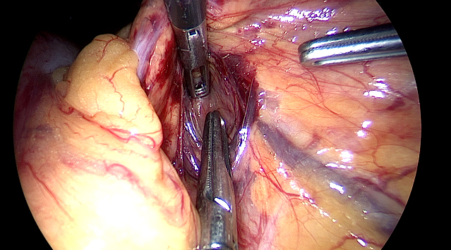 Pancreas dissection near IMV
