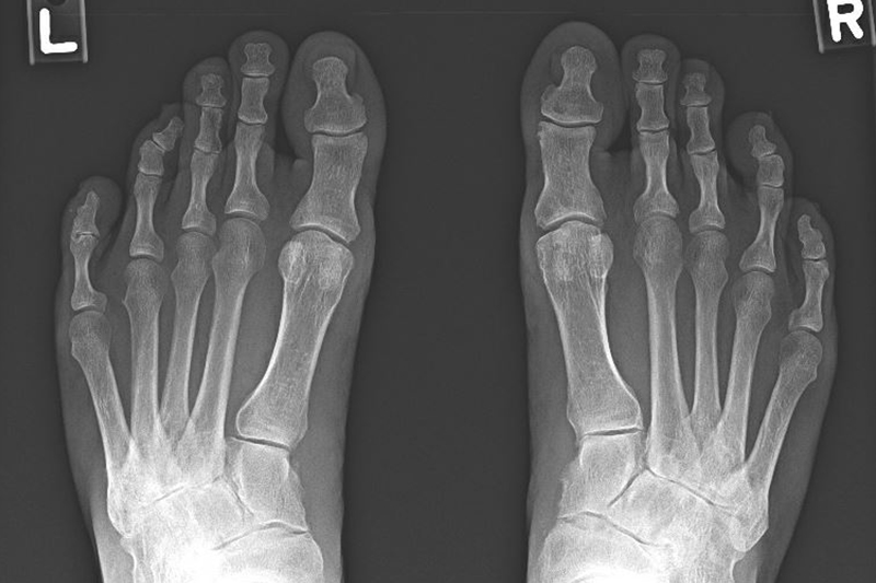 rayos x de la osteoartritis