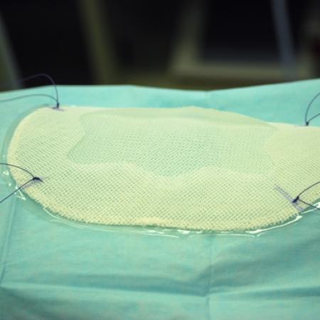 Different surfaces and shapes for laparoscopic mesh