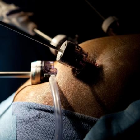 Laparoscopic ports during weight-loss surgery