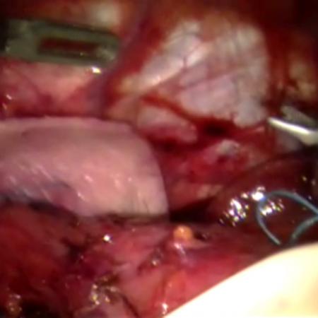Robotic placement of biologic mesh during hiatal hernia repair