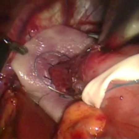 Intracorporeal view of robotic paraesophageal hernia repair