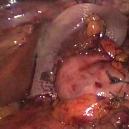 Intracorporeal view of stomach wrap to reconstruct gastroesophageal sphincter
