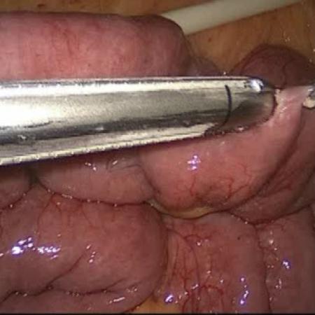 Connecting intestine during gastric bypass