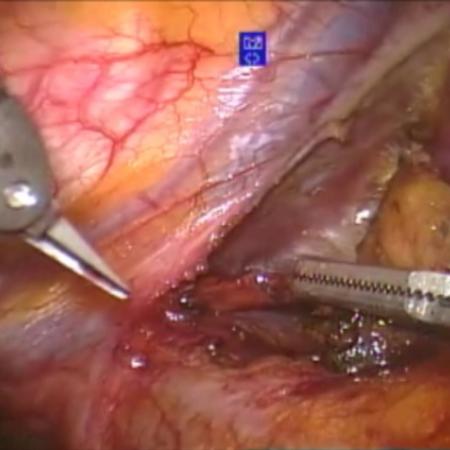 Robotic dissection of superior horns of thymus