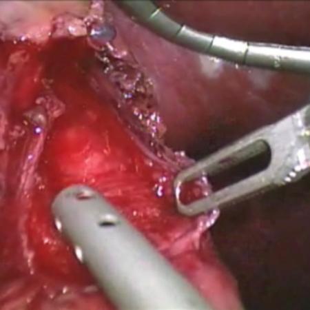 Esophageal mucosa visualized during robotic myotomy