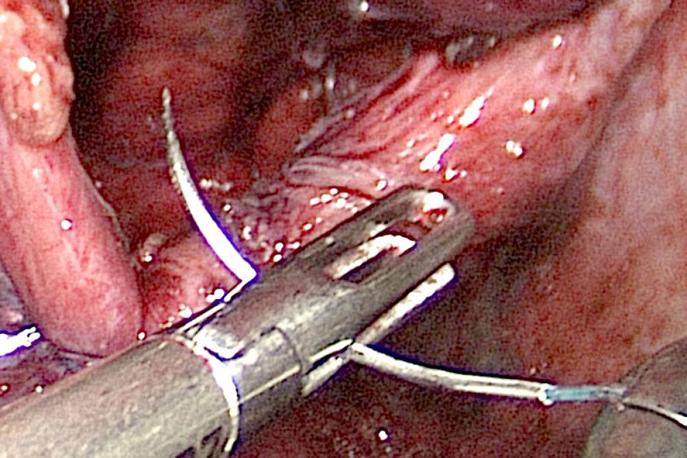 Diaphragmatic hernia being repaired with laparoscopic suturing